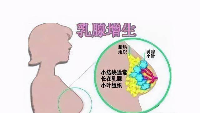 36歲女子摸到胸部疙瘩查出乳腺癌